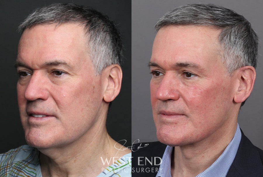Neck Lift before photo. Individual results may vary.