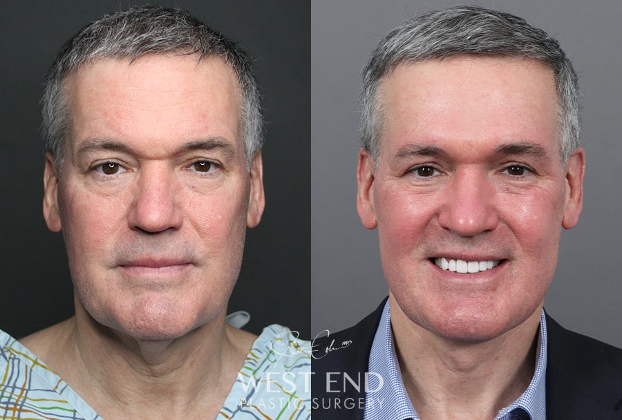 Neck Lift before photo. Individual results may vary.