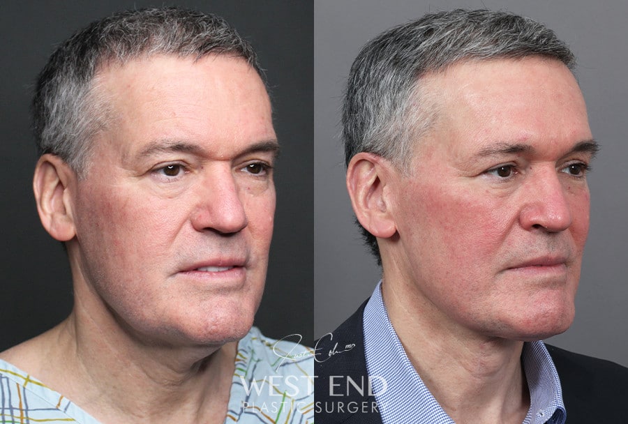 Neck Lift before photo. Individual results may vary.