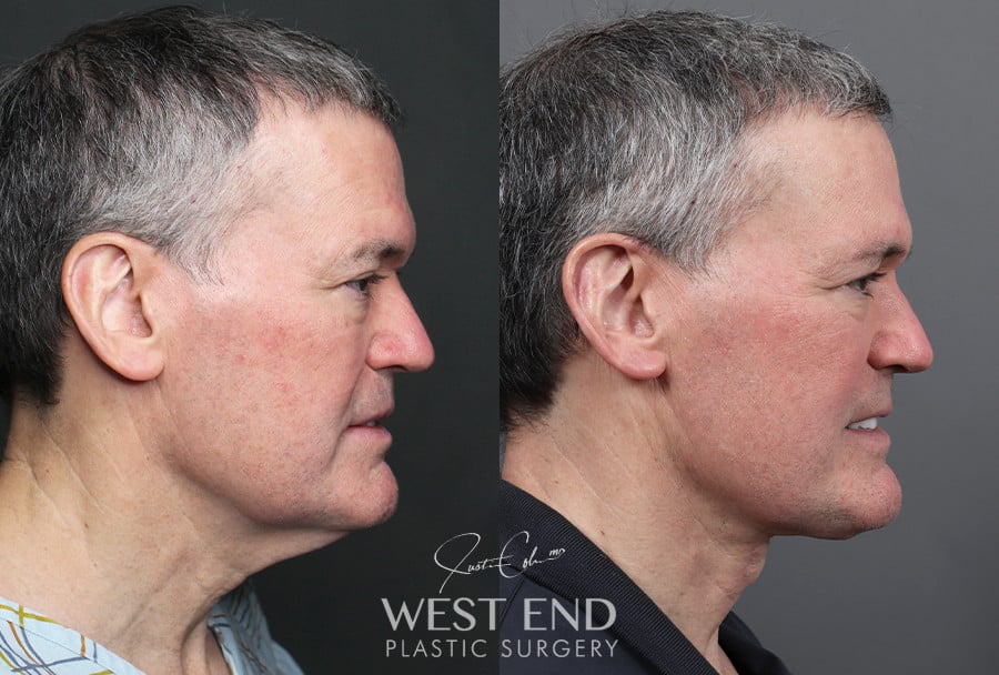 Neck Lift before photo. Individual results may vary.