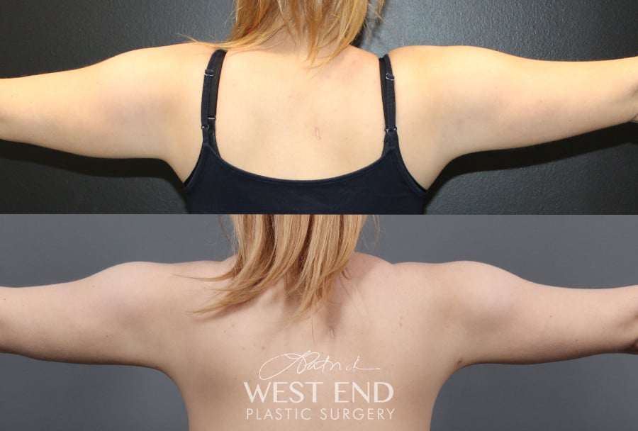 Liposuction and Renuvion Skin Tightening