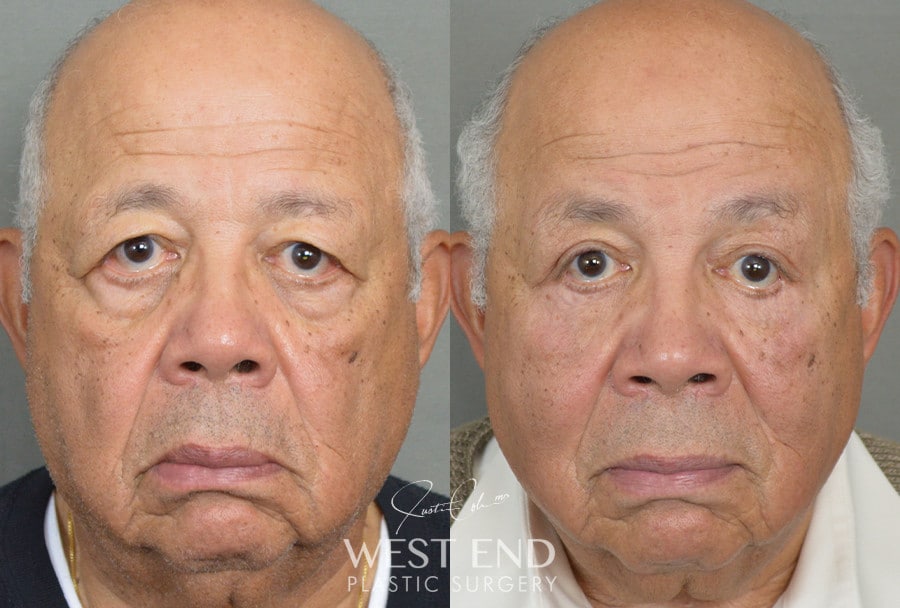 Blepharoplasty & Brow Lift before photo. Individual results may vary.