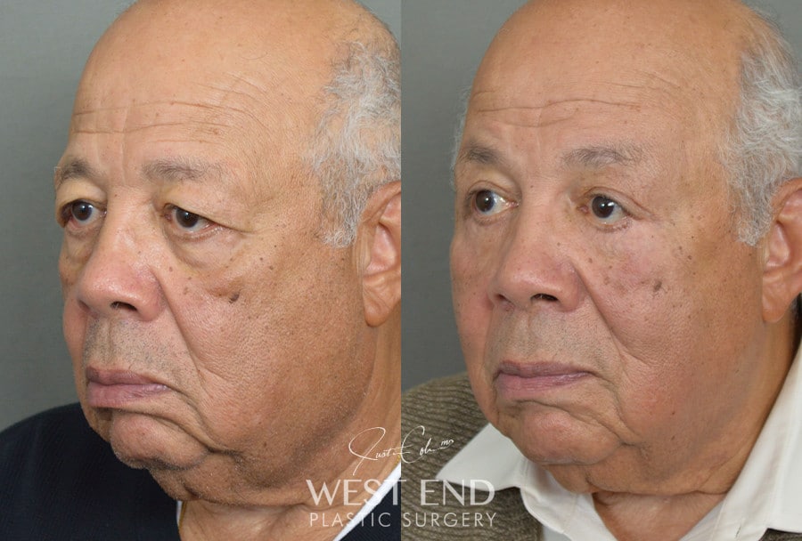 Blepharoplasty & Brow Lift before photo. Individual results may vary.
