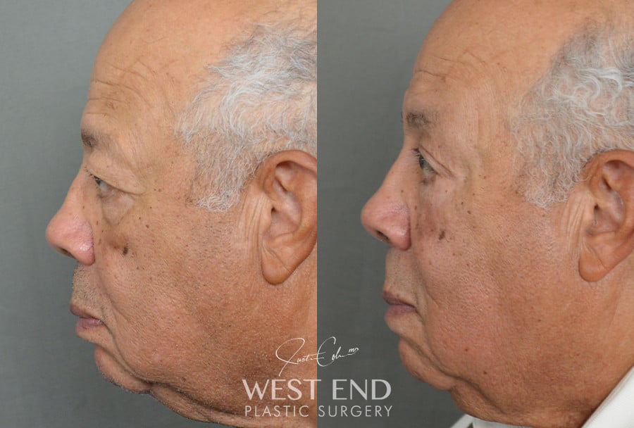 Blepharoplasty & Brow Lift before photo. Individual results may vary.