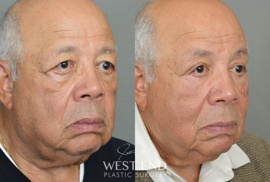 Blepharoplasty & Brow Lift before photo. Individual results may vary.