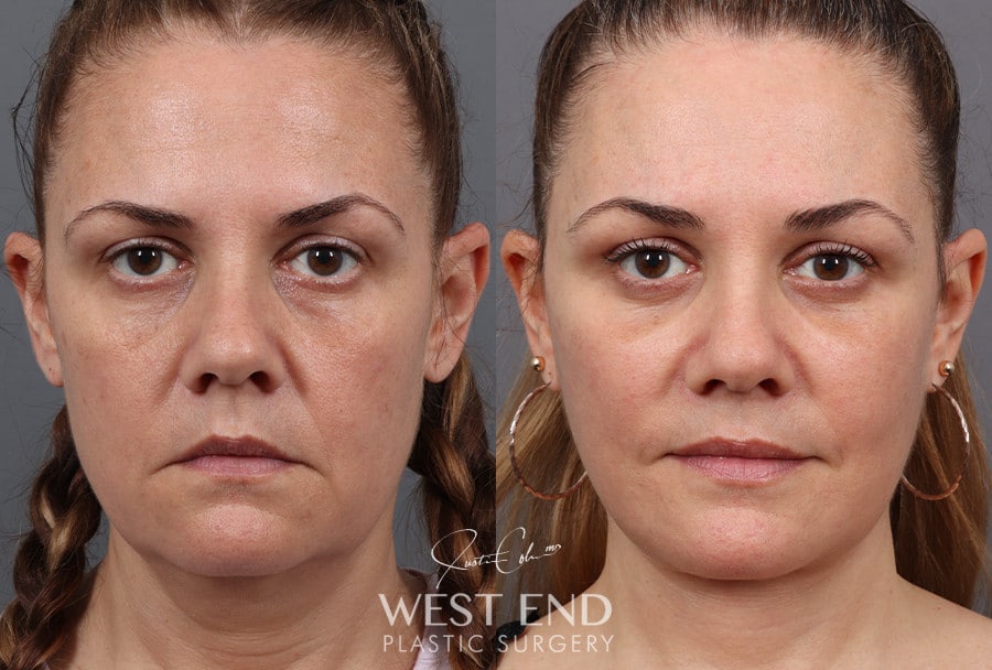 Deep Plane Facelift, Neck Lift & Blepharoplasty with Fat Grafting before photo. Individual results may vary.
