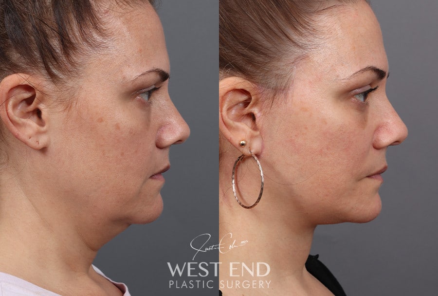 Deep Plane Facelift, Neck Lift & Blepharoplasty with Fat Grafting before photo. Individual results may vary.