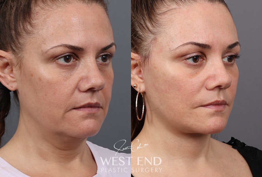 Deep Plane Facelift, Neck Lift & Blepharoplasty with Fat Grafting before photo. Individual results may vary.