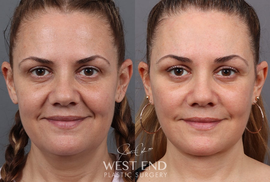 Deep Plane Facelift, Neck Lift & Blepharoplasty with Fat Grafting before photo. Individual results may vary.