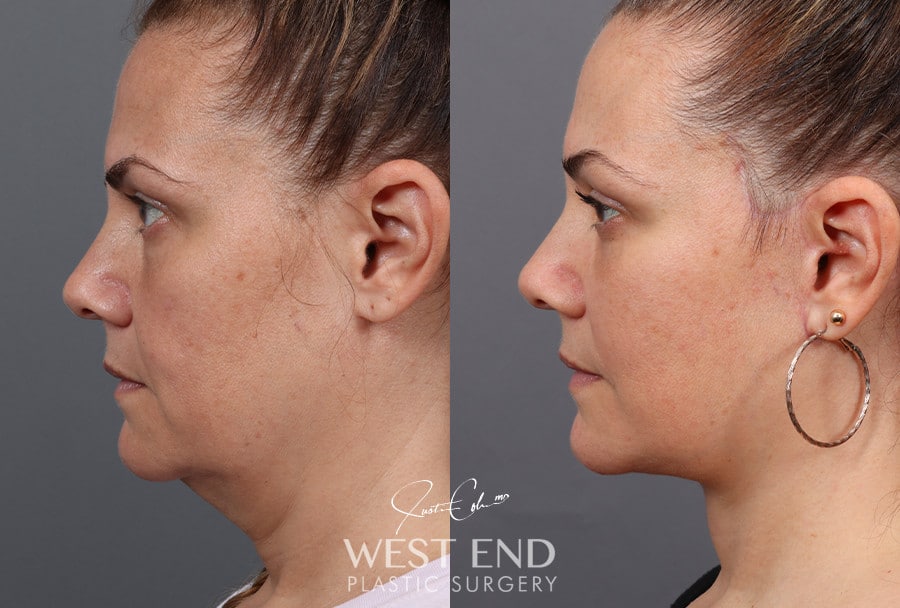 Deep Plane Facelift, Neck Lift & Blepharoplasty with Fat Grafting before photo. Individual results may vary.