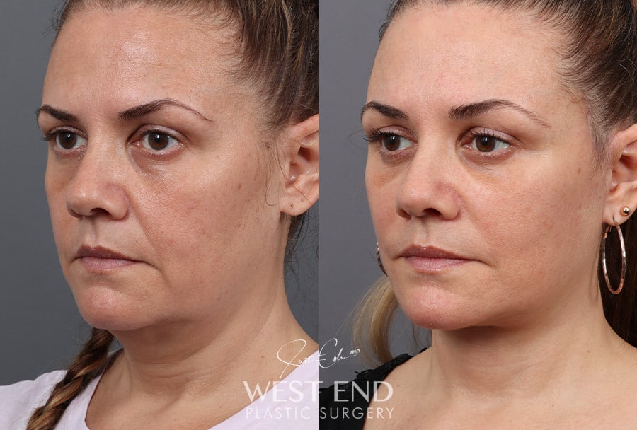 Deep Plane Facelift, Neck Lift & Blepharoplasty with Fat Grafting before photo. Individual results may vary.