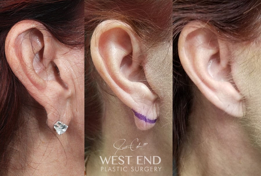 Earlobe Reduction before photo. Individual results may vary.