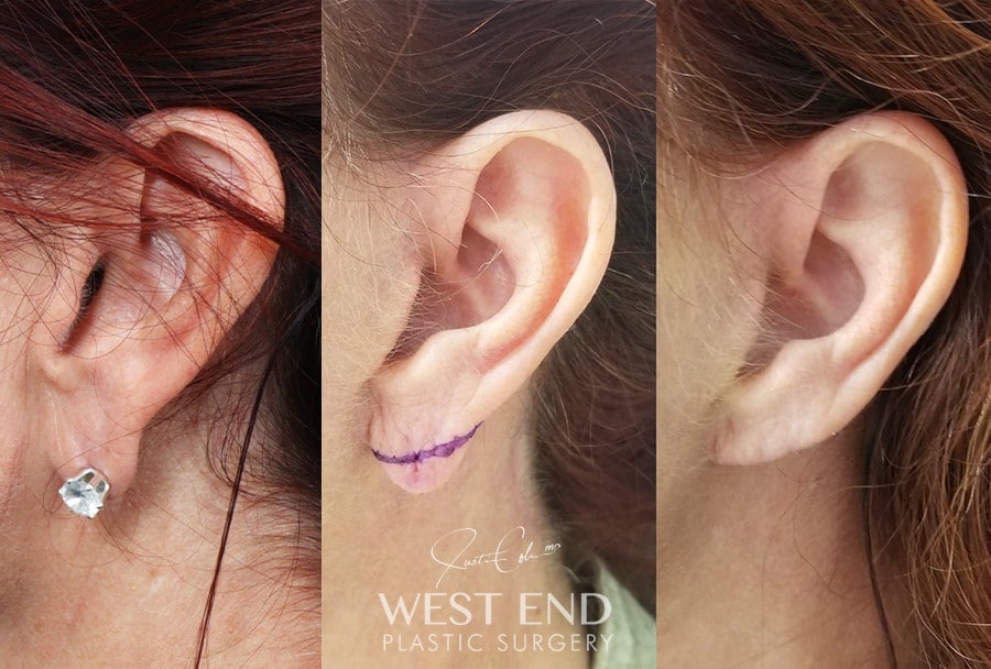 Earlobe Reduction before photo. Individual results may vary.