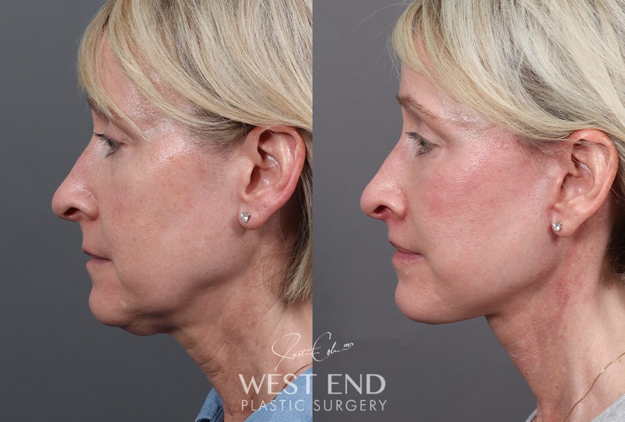 Deep Plane Facelift & Neck Lift, Upper Lip Lift, CO2 Laser Resurfacing, and Facial Fat Grafting before photo. Individual results may vary.