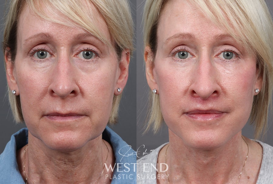 Deep Plane Facelift & Neck Lift, Upper Lip Lift, CO2 Laser Resurfacing, and Facial Fat Grafting before photo. Individual results may vary.