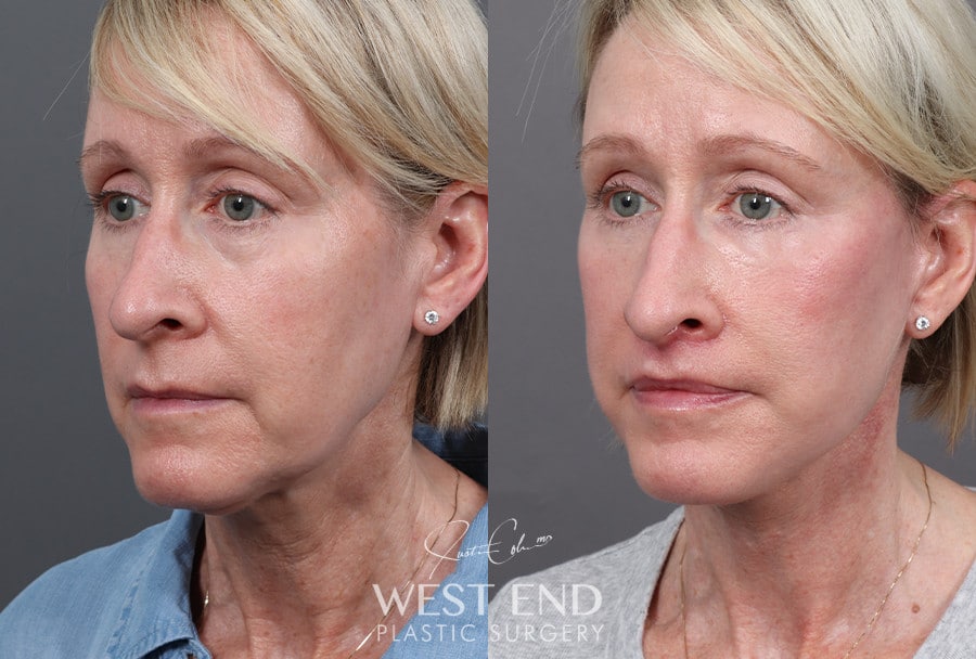 Deep Plane Facelift & Neck Lift, Upper Lip Lift, CO2 Laser Resurfacing, and Facial Fat Grafting before photo. Individual results may vary.