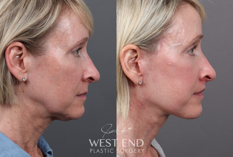 Deep Plane Facelift & Neck Lift, Upper Lip Lift, CO2 Laser Resurfacing, and Facial Fat Grafting before photo. Individual results may vary.