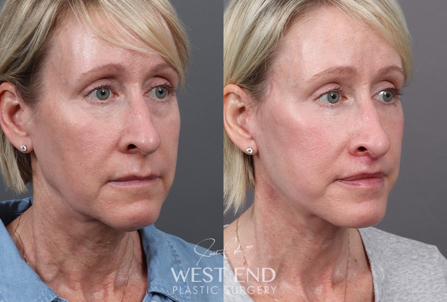 Deep Plane Facelift & Neck Lift, Upper Lip Lift, CO2 Laser Resurfacing, and Facial Fat Grafting before photo. Individual results may vary.