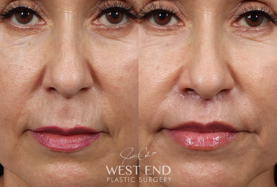 Lip Lift before photo. Individual results may vary.