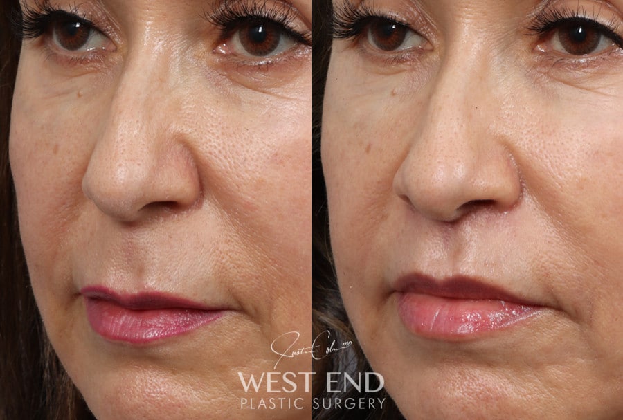 Lip Lift before photo. Individual results may vary.