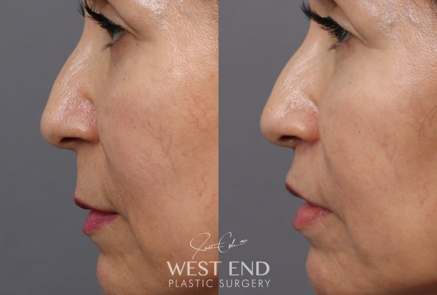 Lip Lift before photo. Individual results may vary.