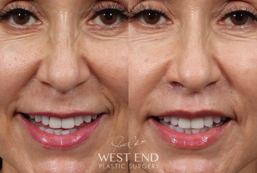 Lip Lift before photo. Individual results may vary.