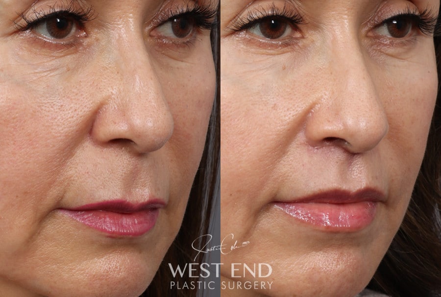 Lip Lift before photo. Individual results may vary.