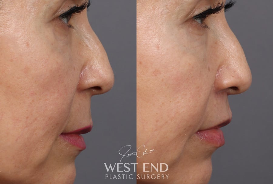 Lip Lift before photo. Individual results may vary.