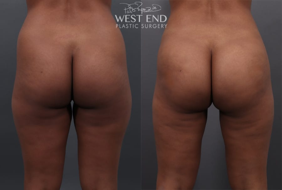 Brazilian Butt Lift