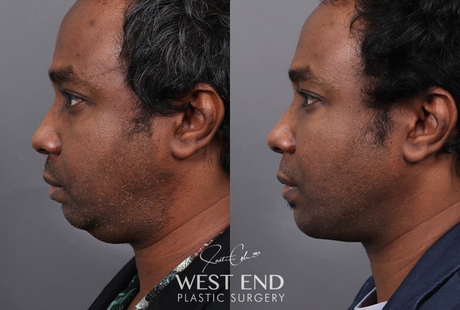Chin Implant, Liposuction & Buccal Fat Reduction before photo. Individual results may vary.