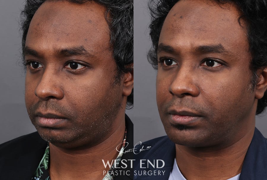 Chin Implant, Liposuction & Buccal Fat Reduction before photo. Individual results may vary.
