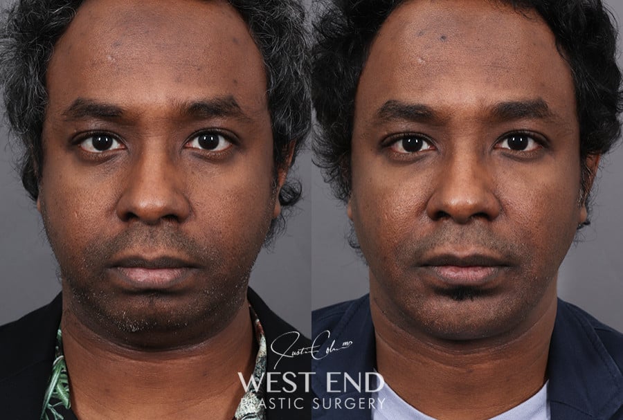 Chin Implant, Liposuction & Buccal Fat Reduction before photo. Individual results may vary.