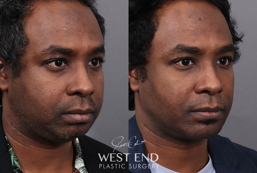 Chin Implant, Liposuction & Buccal Fat Reduction before photo. Individual results may vary.