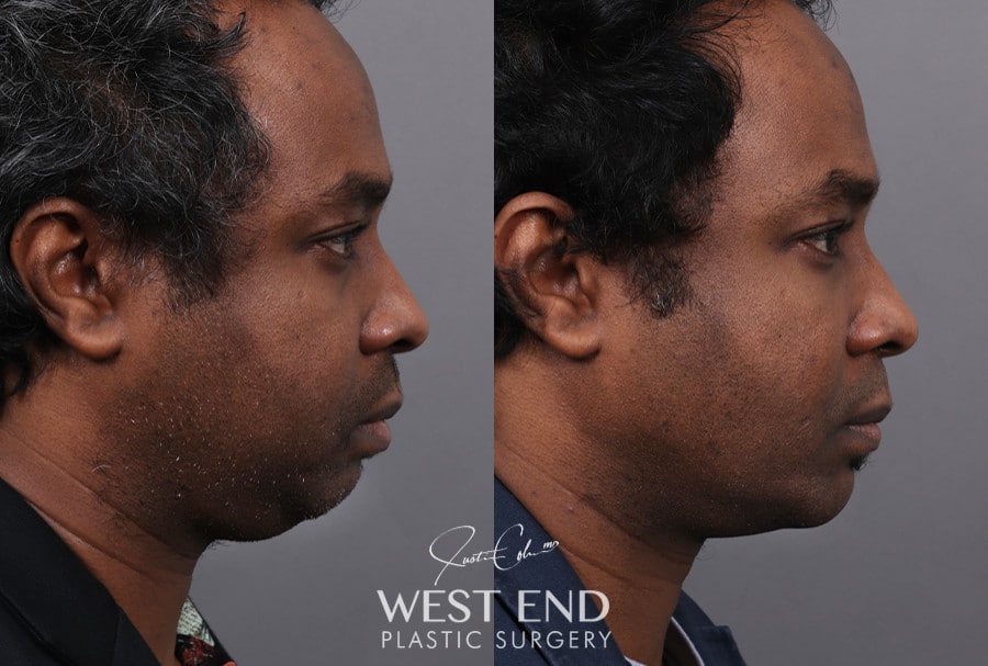 Chin Implant, Liposuction & Buccal Fat Reduction before photo. Individual results may vary.