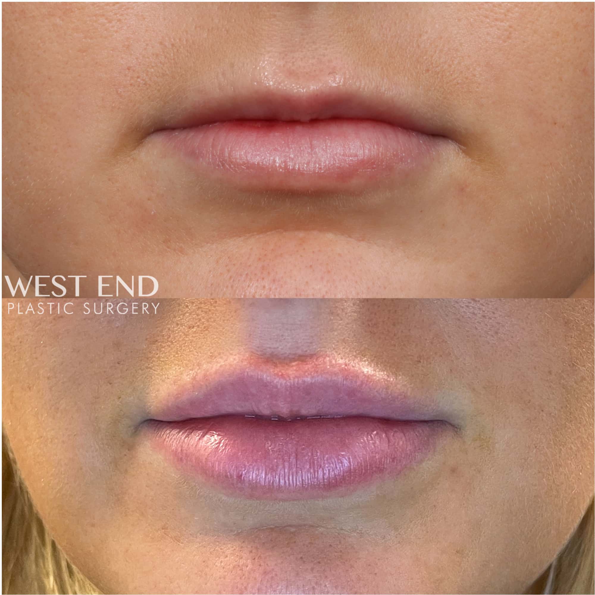 Lip Filler