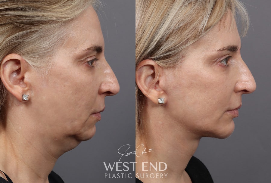 Deep Plane Facelift, Neck Lift, Chin Implant, Temporal Brow Lift & Blepharoplasty before photo. Individual results may vary.