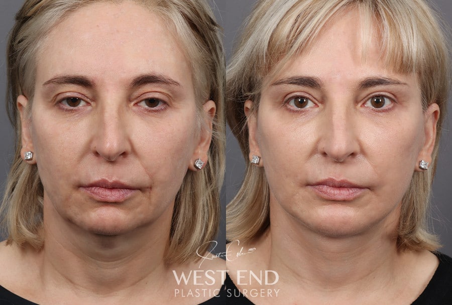 Deep Plane Facelift, Neck Lift, Chin Implant, Temporal Brow Lift & Blepharoplasty before photo. Individual results may vary.