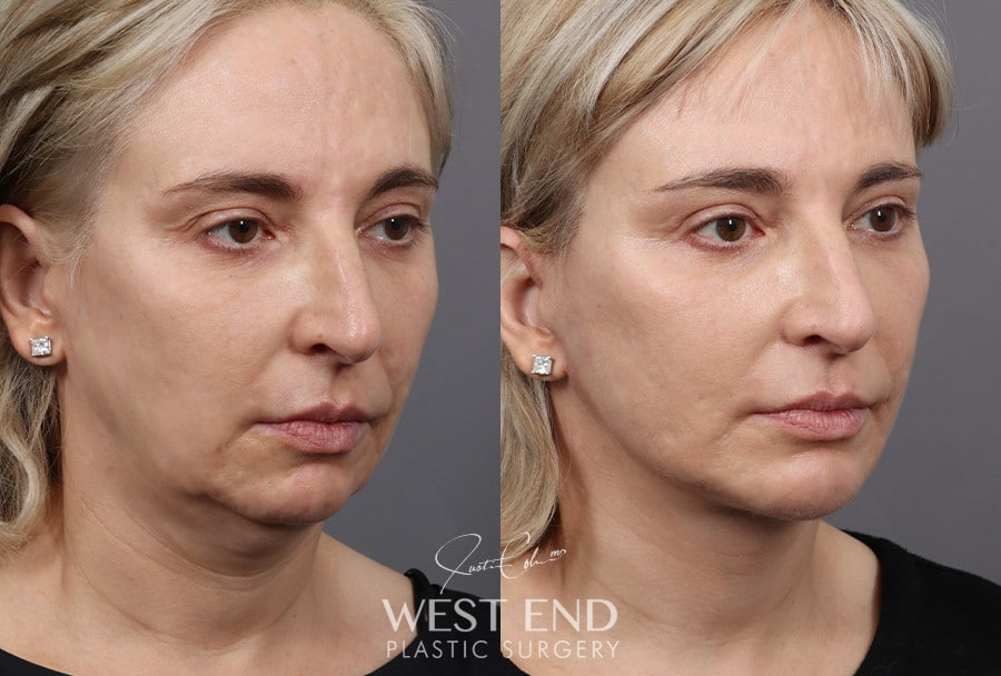 Deep Plane Facelift, Neck Lift, Chin Implant, Temporal Brow Lift & Blepharoplasty before photo. Individual results may vary.
