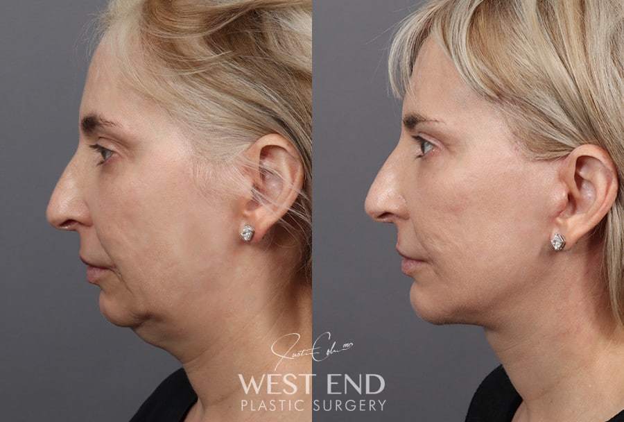 Deep Plane Facelift, Neck Lift, Chin Implant, Temporal Brow Lift & Blepharoplasty before photo. Individual results may vary.