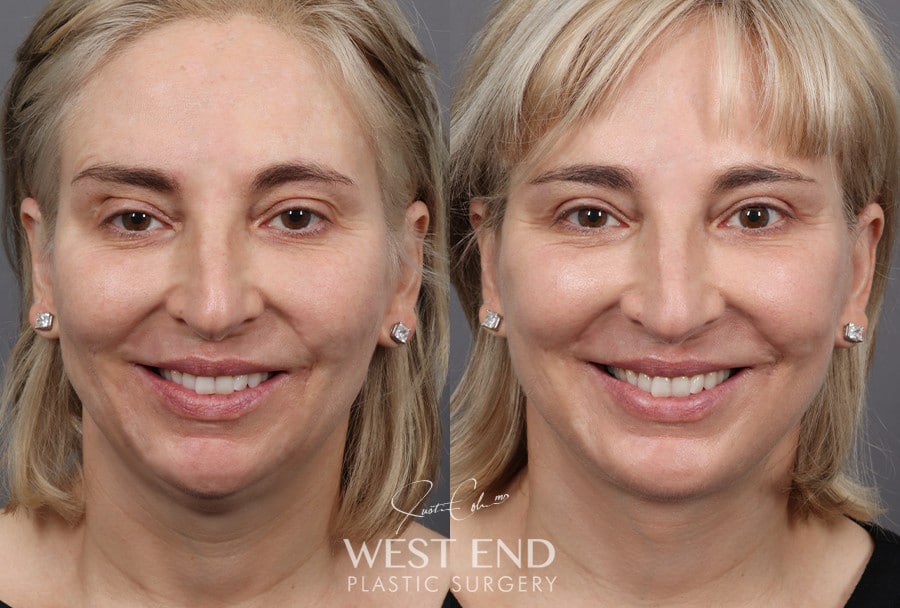 Deep Plane Facelift, Neck Lift, Chin Implant, Temporal Brow Lift & Blepharoplasty before photo. Individual results may vary.