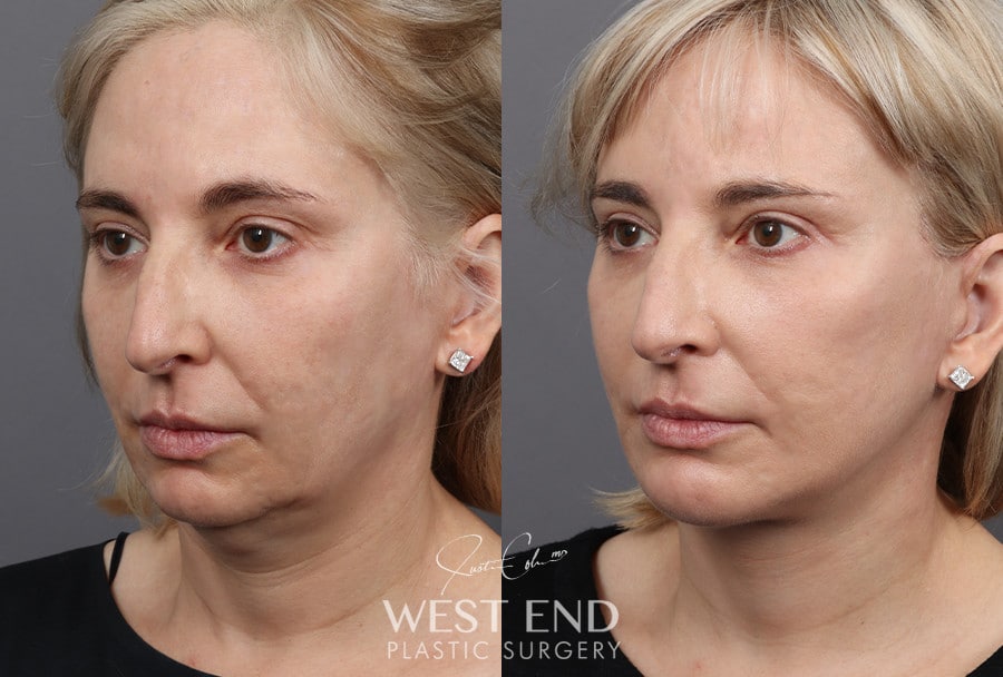 Deep Plane Facelift, Neck Lift, Chin Implant, Temporal Brow Lift & Blepharoplasty before photo. Individual results may vary.