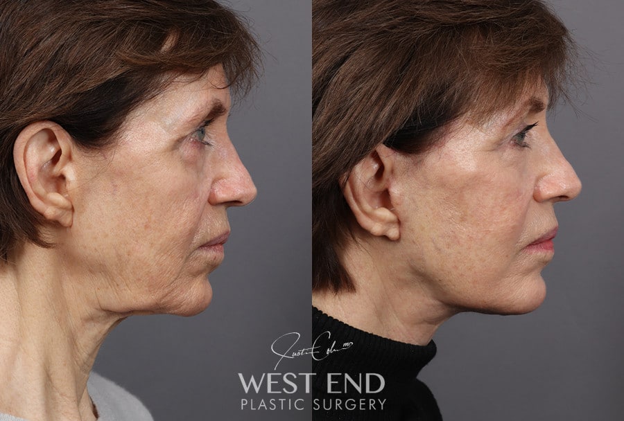 Deep Plane Facelift & Neck Lift before photo. Individual results may vary.