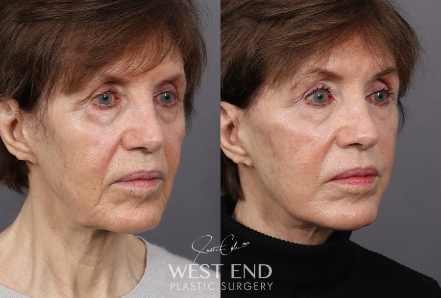 Deep Plane Facelift & Neck Lift before photo. Individual results may vary.