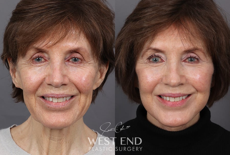 Deep Plane Facelift & Neck Lift before photo. Individual results may vary.