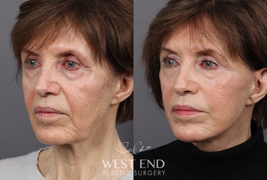 Deep Plane Facelift & Neck Lift before photo. Individual results may vary.