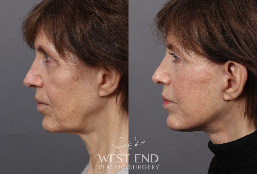 Deep Plane Facelift & Neck Lift before photo. Individual results may vary.