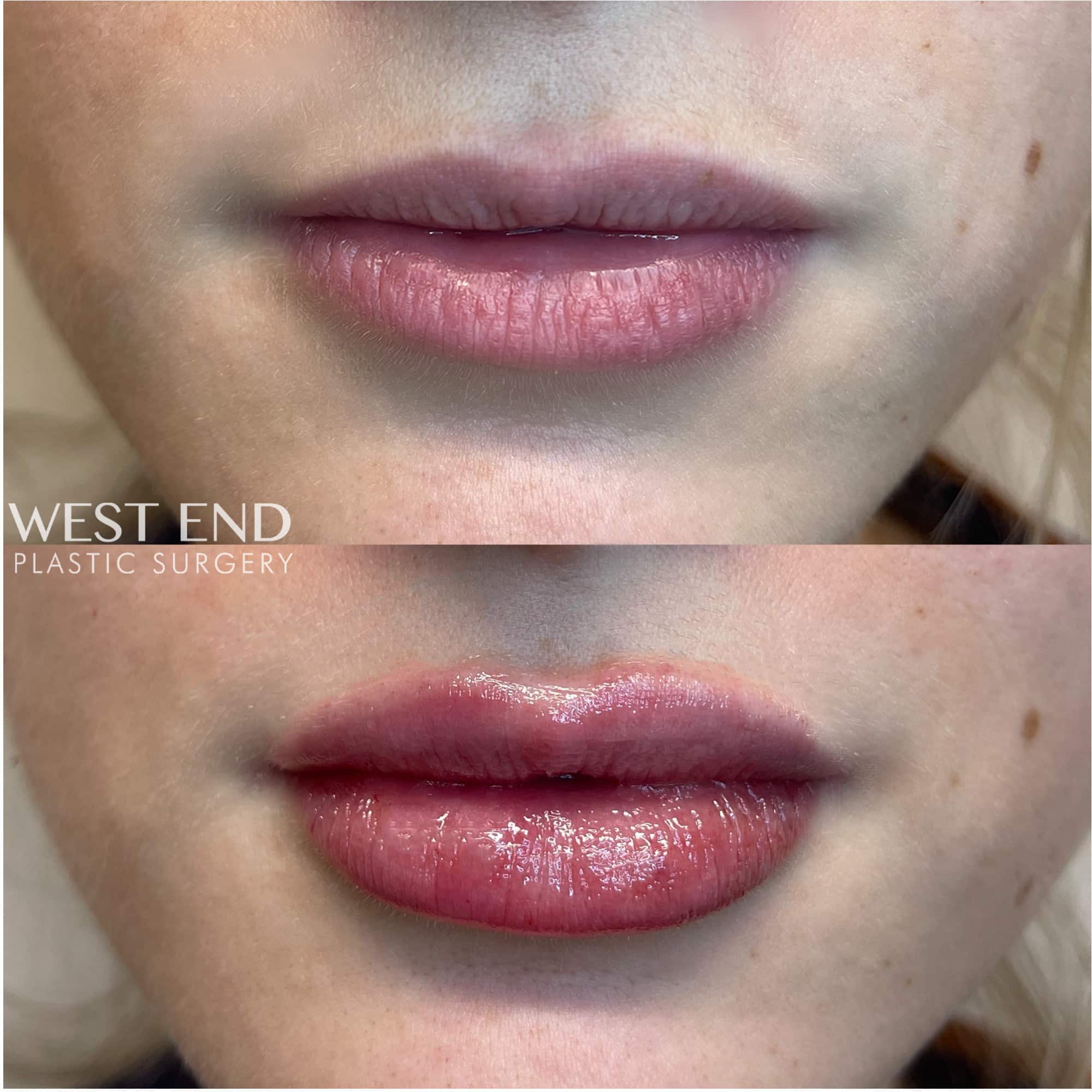 Lip Filler