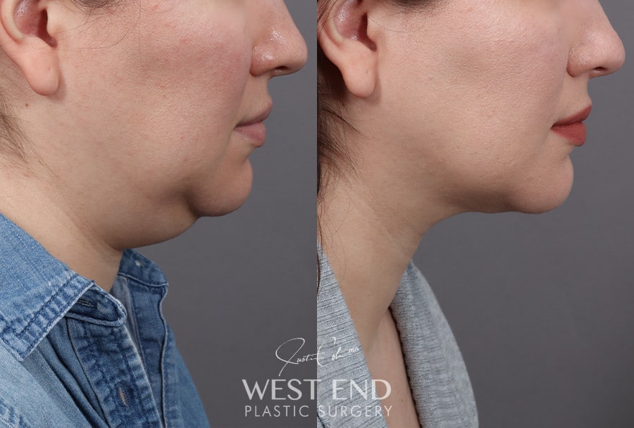 Submental Liposuction before photo. Individual results may vary.