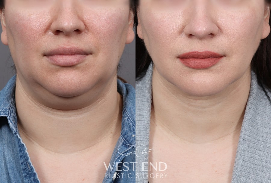 Submental Liposuction before photo. Individual results may vary.