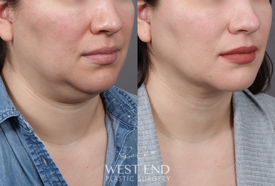 Submental Liposuction before photo. Individual results may vary.